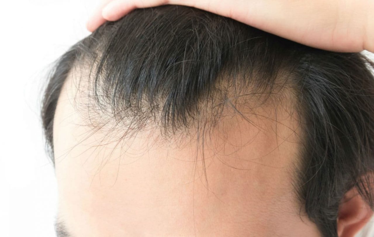 Alopecia Qué es tipos de alopecia causas síntomas y tratamientos